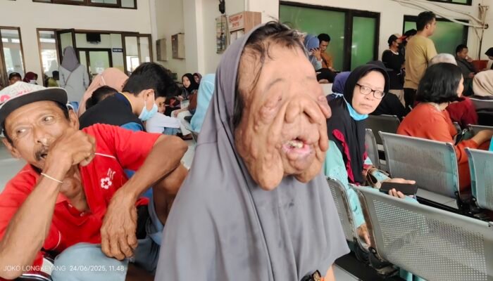 Pilu, Apakah Wajah Kholipah Bisa Diobati? 